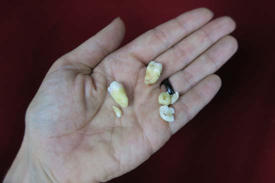 extracted wisdom teeth shown held on a persons palm