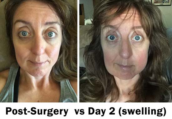 wisdom teeth swelling post surgery vs day 2, 3 & 4